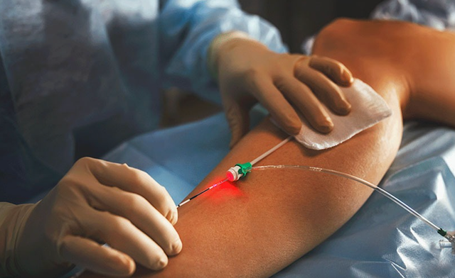 Tratamento de varizes com laser permite alta no mesmo dia e recuperação mais rápida