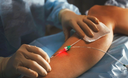 Tratamento de varizes com laser permite alta no mesmo dia e recuperação mais rápida